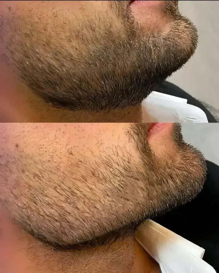 تخفیفات بلک فرایدی ژل و بوتاکس درمطب|خدمات آرایشگری و زیبایی|خرم‌آباد, |دیوار