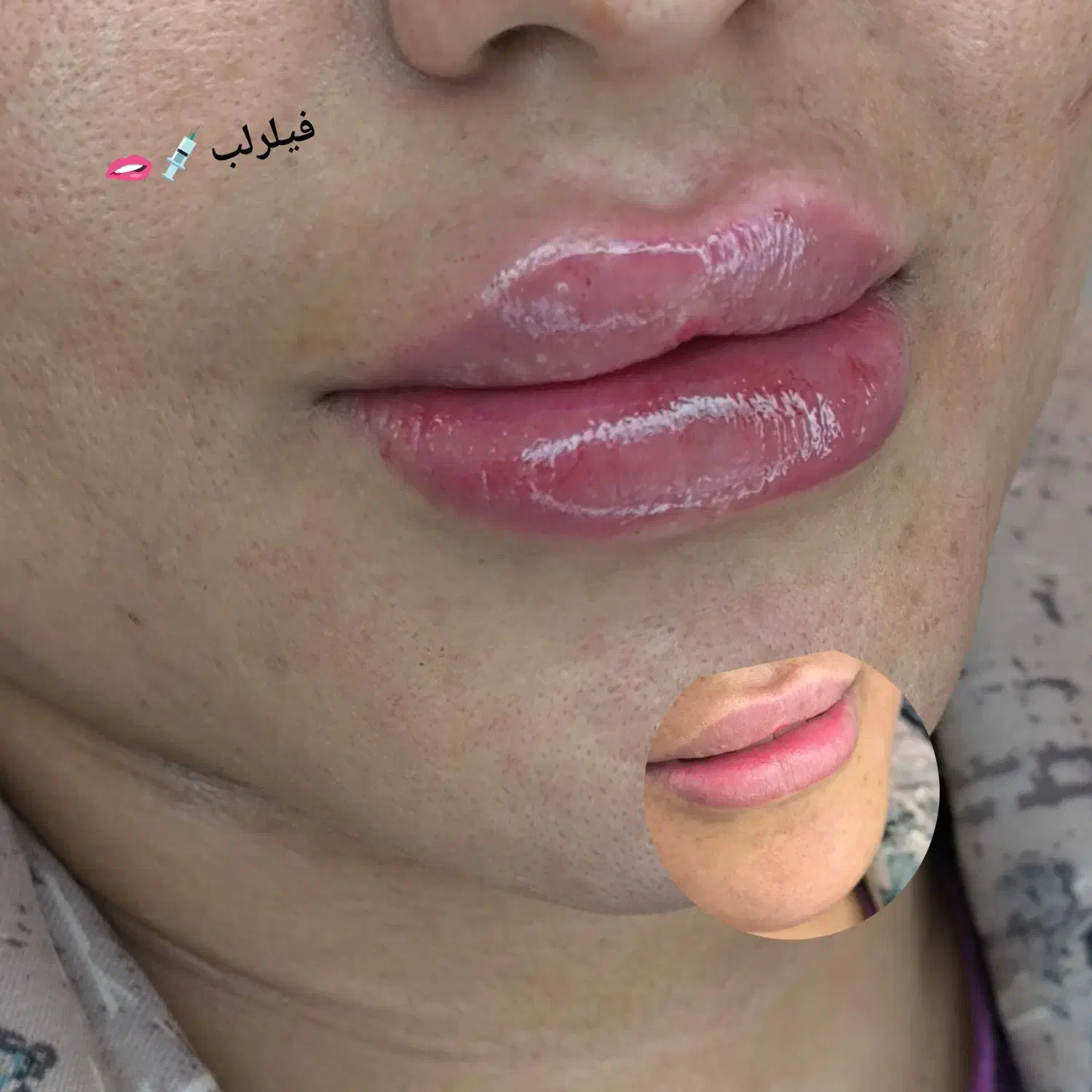 ژل وبوتاکس|خدمات آرایشگری و زیبایی|ایذه, |دیوار