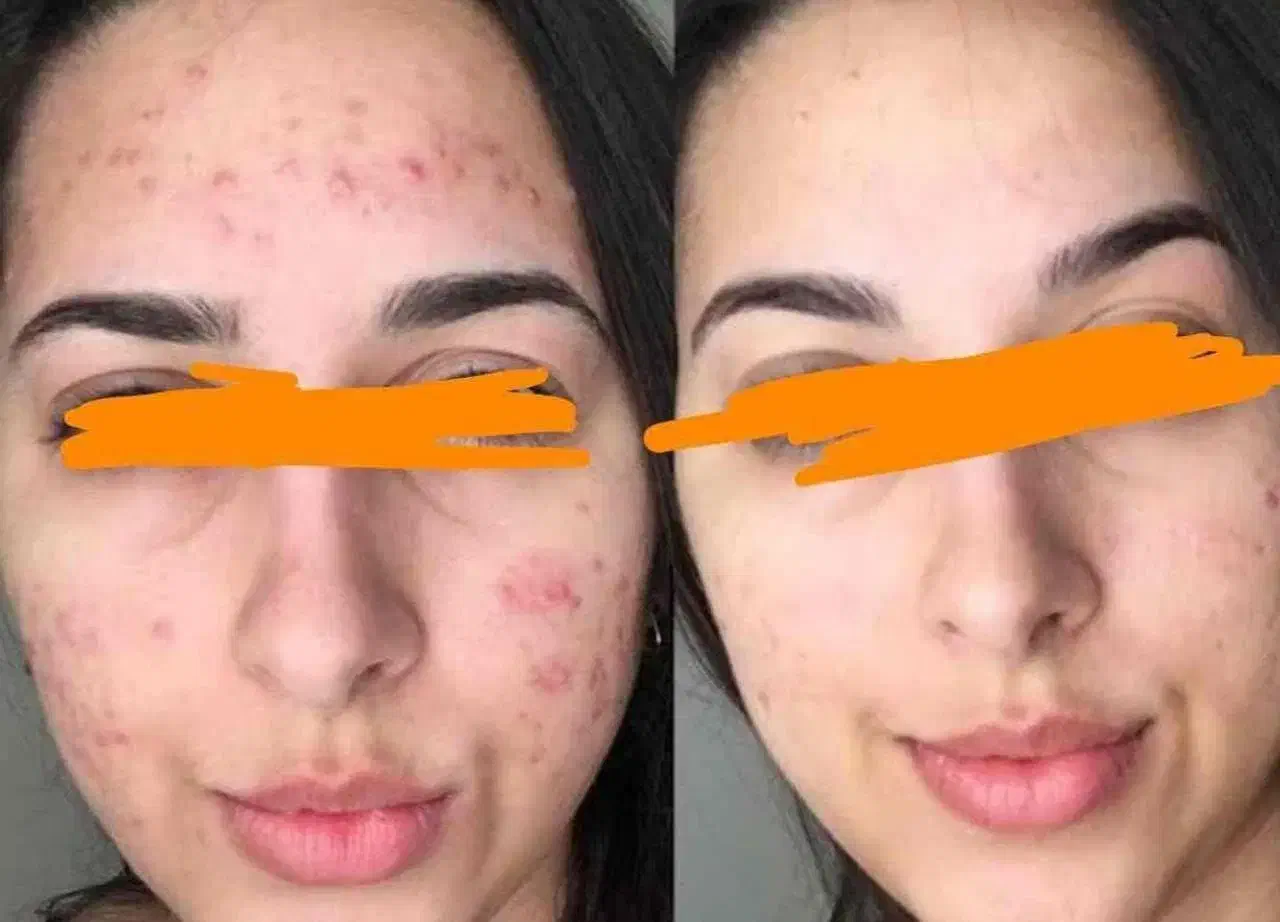 اگه قند داری چربی داری کلی مشکلات بیا|آرایشی، بهداشتی، درمانی|رشت, کوی حسینی|دیوار