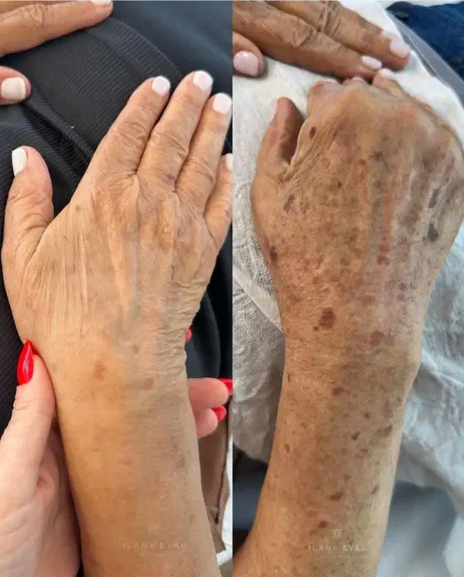 جشنوار یلدا درمان تضمینی کک ومک/لک/خال/فقط در1جلسه|خدمات آرایشگری و زیبایی|اصفهان, باغ زیار|دیوار