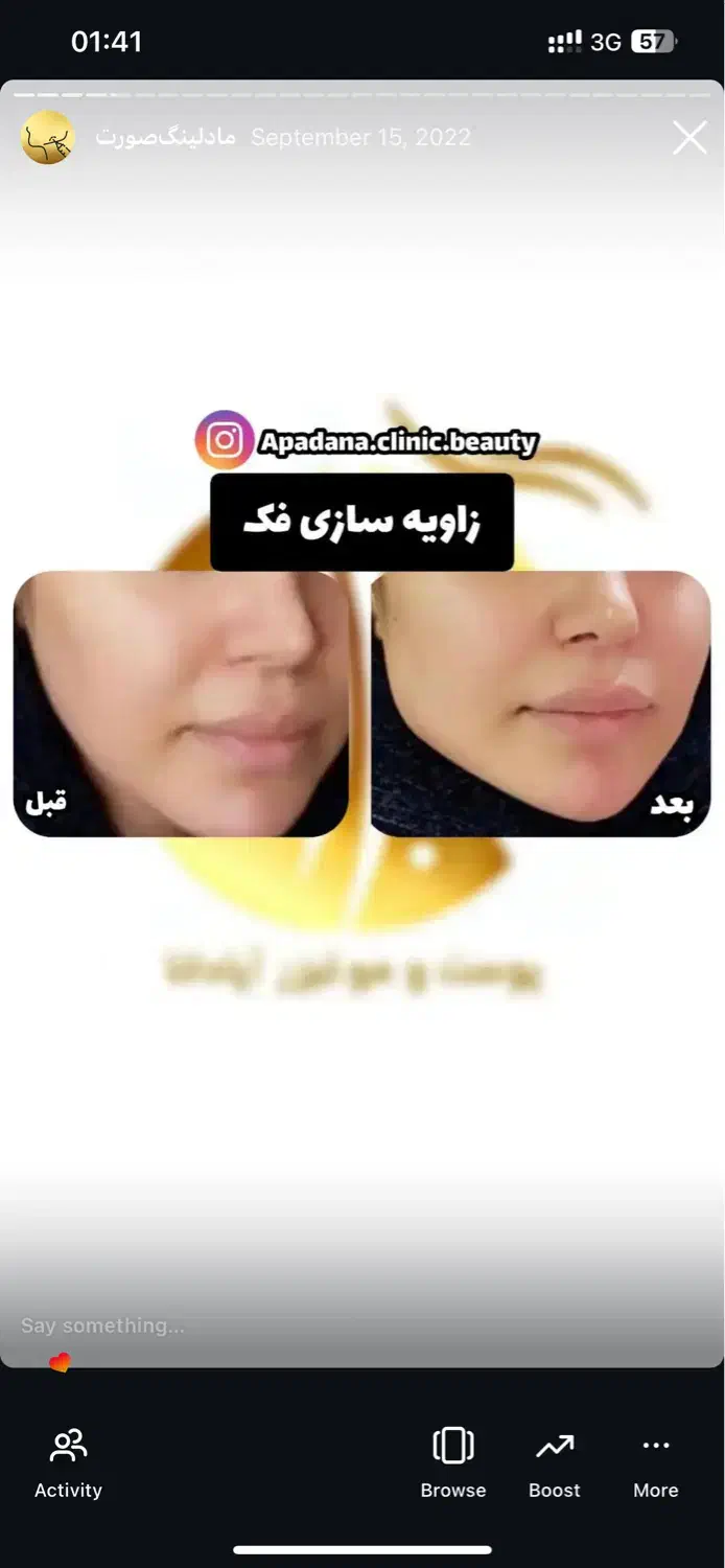 جشنواره تزریق ژل ۳۸۰ هزاروبوتاکس توسط کادردرمان|خدمات آرایشگری و زیبایی|اندیمشک, |دیوار