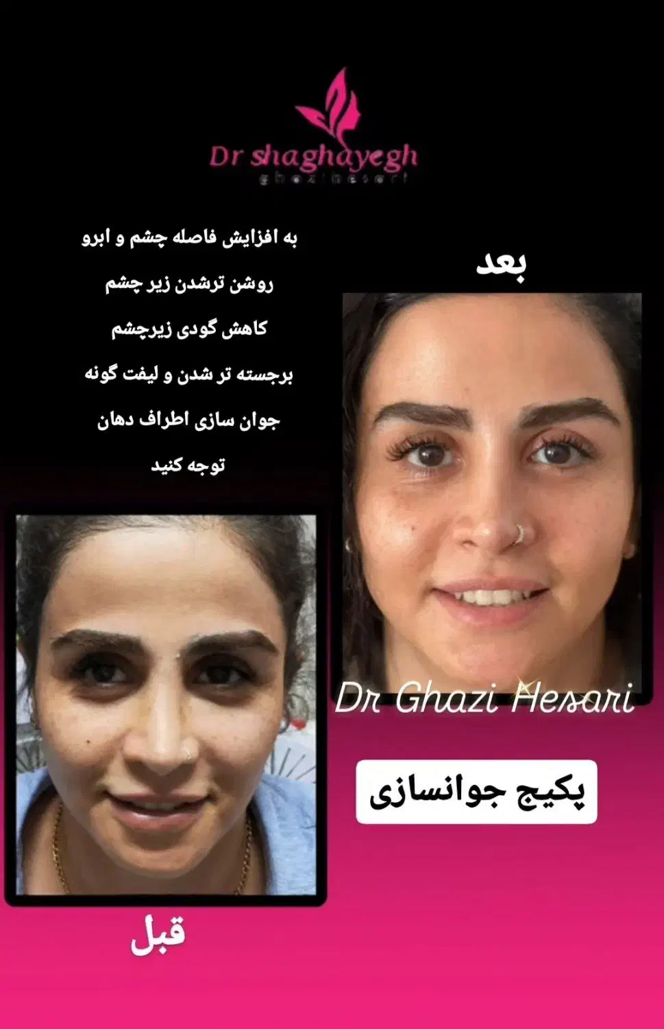 لیزر تزریق بوتاکس ژل فیلر مزوتراپی هایفو توسط پزشک|خدمات آرایشگری و زیبایی|پرند, فاز ۲|دیوار