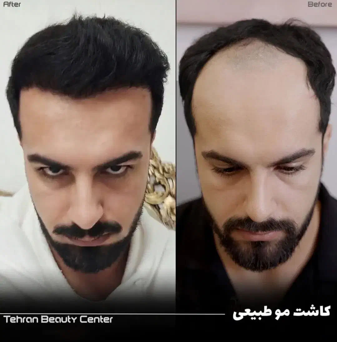 کلینیک فوق تخصصی/کاشت مو / ابرو|خدمات آرایشگری و زیبایی|زاهدان, |دیوار