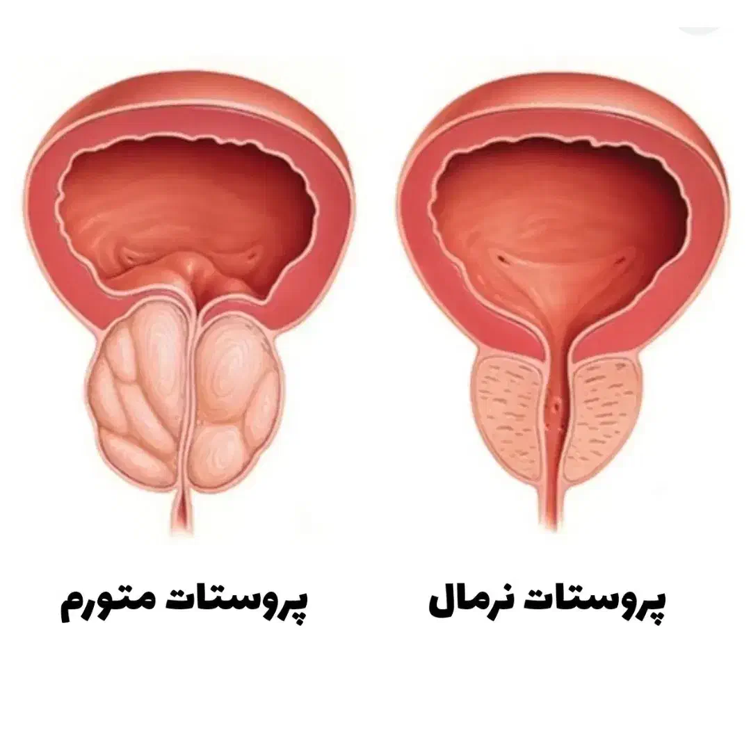 پروستات رفع ۱۰۰٪|آرایشی، بهداشتی، درمانی|ساری, |دیوار