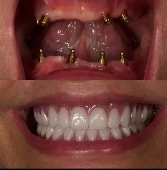 دندانپزشکی ایمپلنت/متخصص فک و صورت/+3000کاشت موفق|خدمات زیبایی و سلامت|تبریز, |دیوار