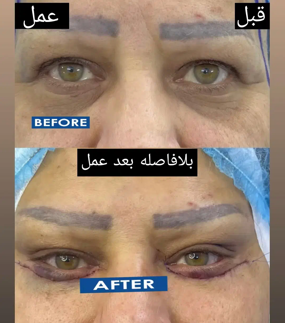 جشنواره بلفاروپلاستی و دیگر خدمات زیبایی|خدمات آرایشگری و زیبایی|کرمانشاه, |دیوار