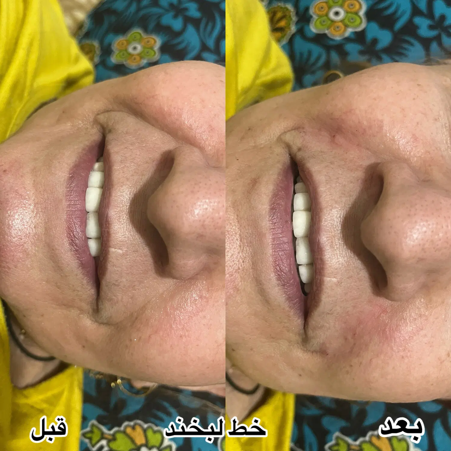 جشنواره آفر ویژه ژل سیسی 770 و بوتاکس 900|خدمات زیبایی و سلامت|شیراز, رازی|دیوار