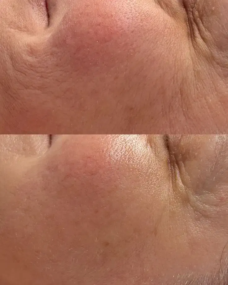 هایفو/لیفت پوست/کانتورینگ صورت/رفع غبغب|خدمات آرایشگری و زیبایی|مسجد سلیمان, |دیوار