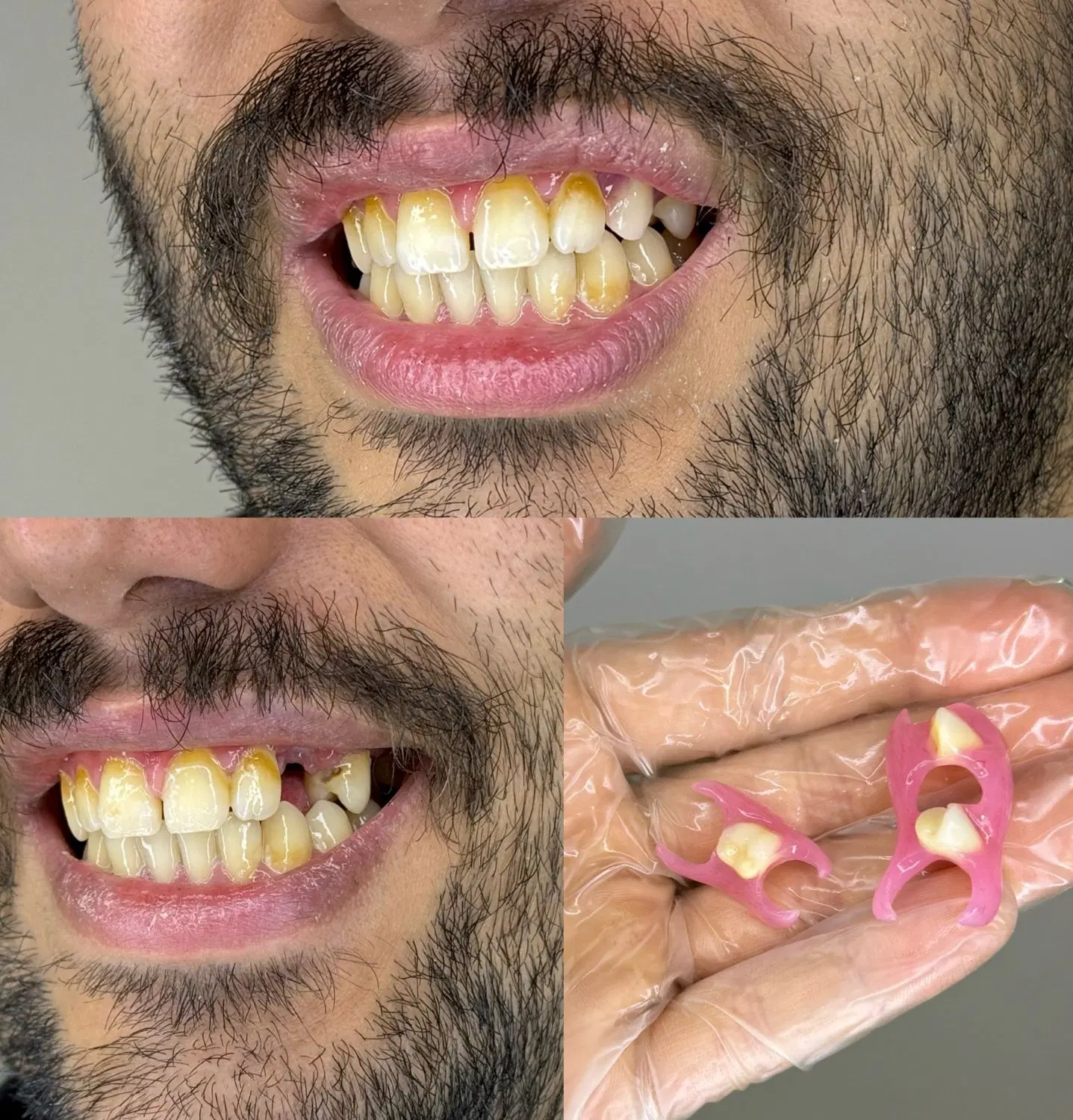 دندان مصنوعی + لابراتوار دندانسازی با گارانتی|خدمات زیبایی و سلامت|تهران, شهرک ولیعصر جنوبی|دیوار