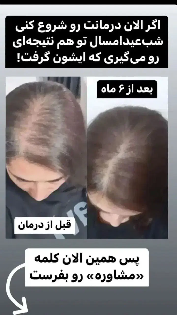 درمان قطعی ریزش مو|آرایشی، بهداشتی، درمانی|اهواز, شهرک نفت|دیوار