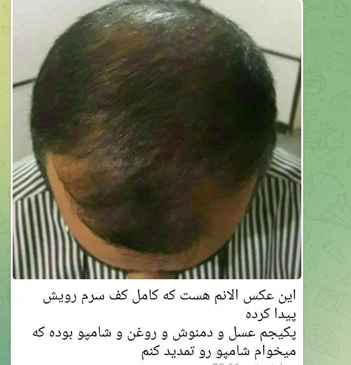 رویش مجدد مو|آرایشی، بهداشتی، درمانی|کوهدشت, |دیوار