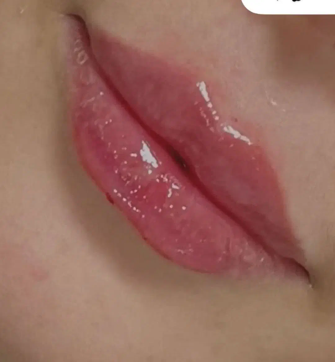 فیلر وبوتاکس|خدمات آرایشگری و زیبایی|گرگان, |دیوار