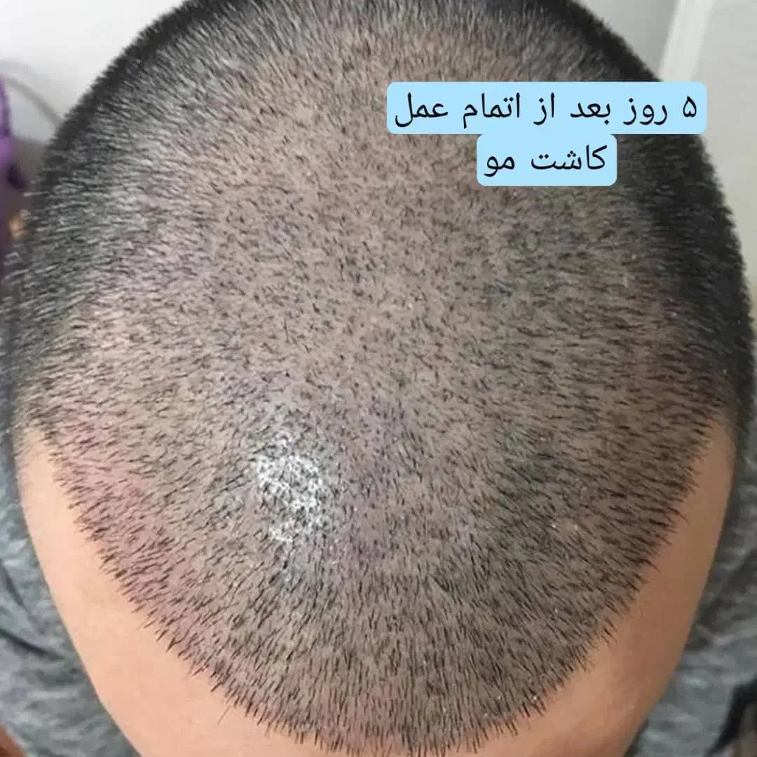 کاشت مو تضمینی|خدمات آرایشگری و زیبایی|شیراز, میرزاکوچک خان|دیوار