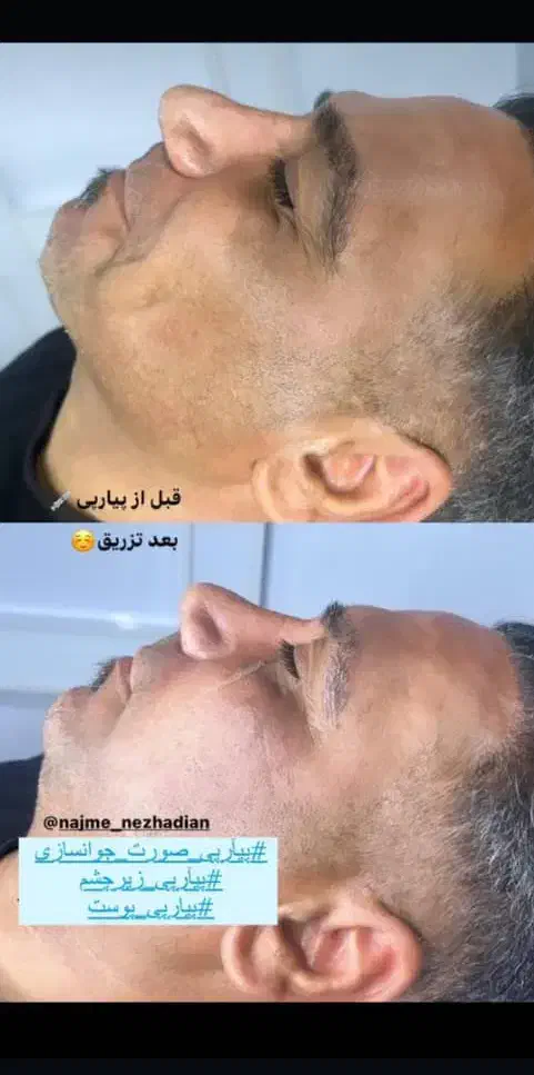 ژل بدن وصورت آموزش  تزریق دراهواز|خدمات آرایشگری و زیبایی|اهواز, کیانپارس |دیوار