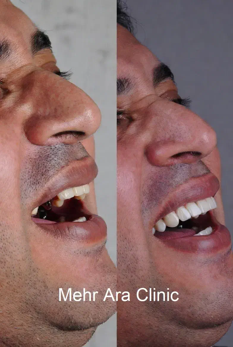 ایمپلنت با روکش هدیه 12.600 محدود|خدمات آرایشگری و زیبایی|تهران, ستارخان|دیوار