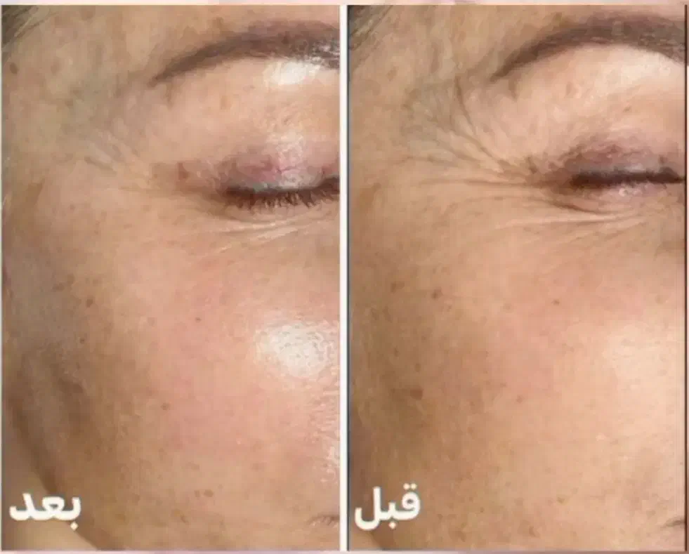 کرم بوتاکس|آرایشی، بهداشتی، درمانی|مراغه, |دیوار