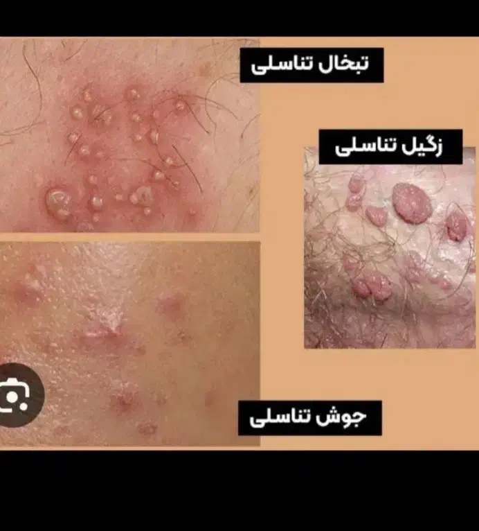 زگیل تناسلیhpv و مشکلات جنسی|خدمات آرایشگری و زیبایی|مینودشت, |دیوار
