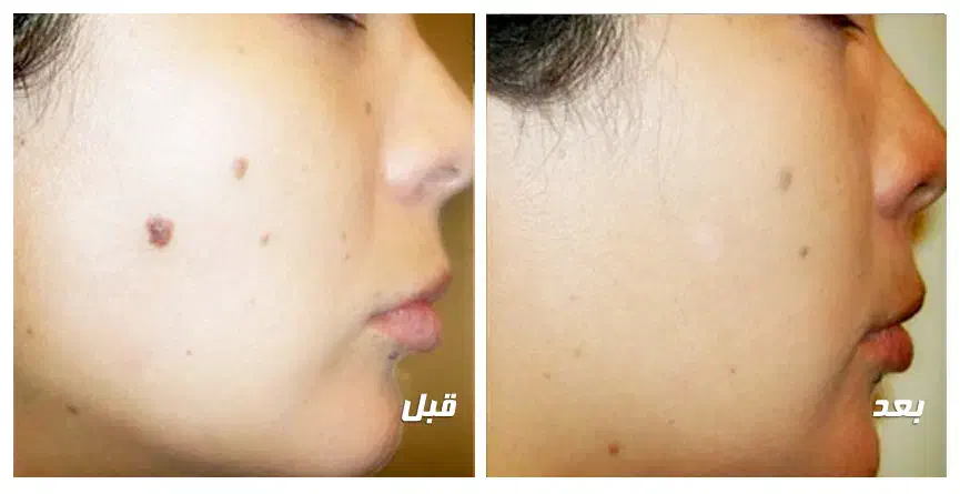 حذف خال، کک و مک و زوائد پوستی با کمترین قیمت|خدمات آرایشگری و زیبایی|یاسوج, |دیوار