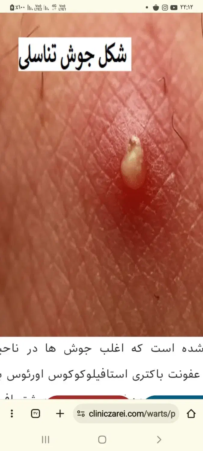 علاج بیماری زگیل تناسلی|آرایشی، بهداشتی، درمانی|قائم‌شهر, |دیوار