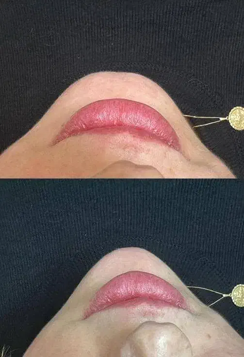 بمب تخفیف ژل و بوتاکس|خدمات آرایشگری و زیبایی|بندر امام خمینی, |دیوار