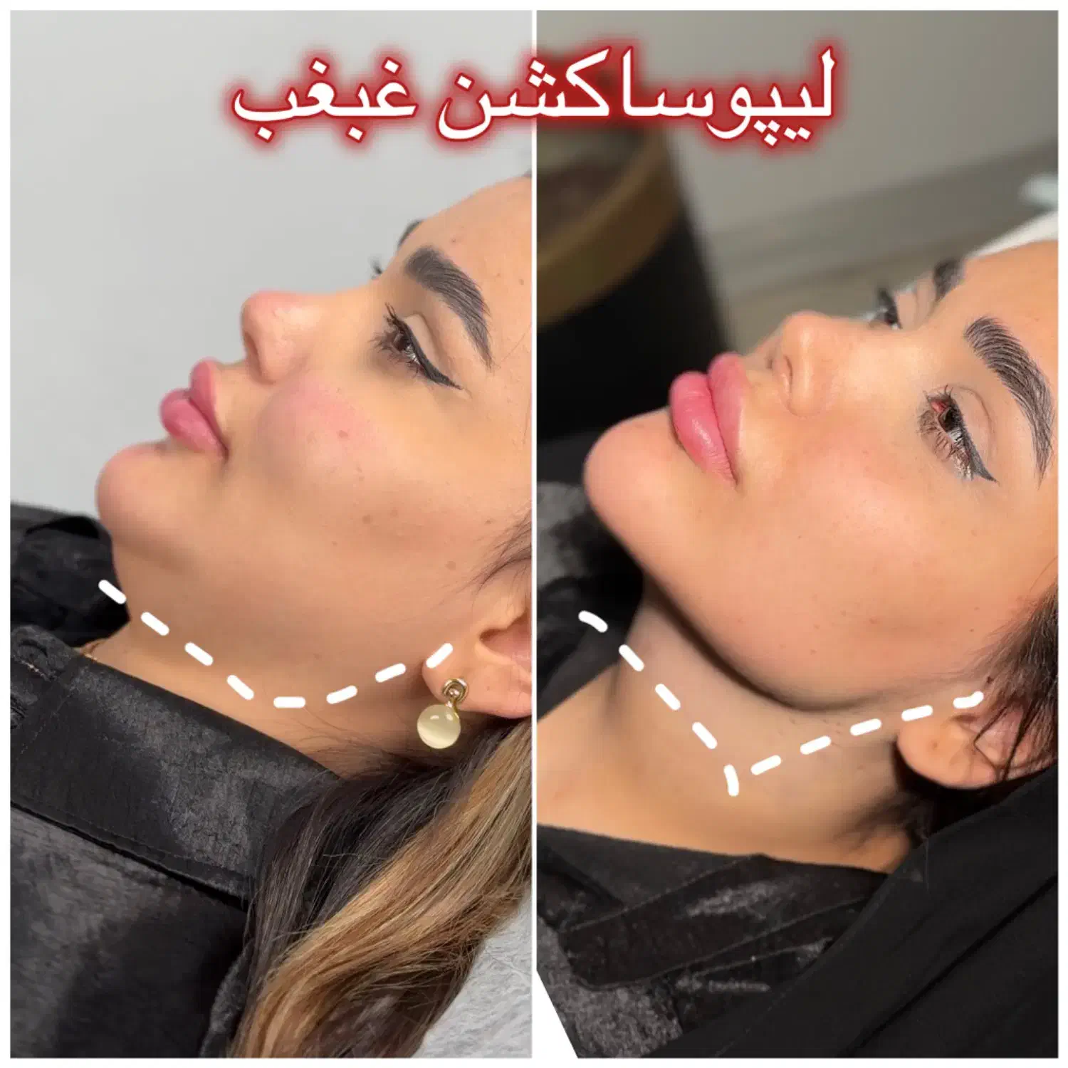 تخلیه چربی غبغب|خدمات آرایشگری و زیبایی|تهران, ایوانک|دیوار