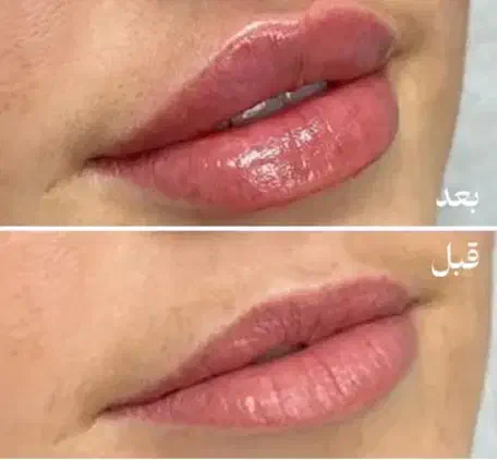 مدل ژل/فیلر لب|خدمات آرایشگری و زیبایی|تهران, قلهک|دیوار