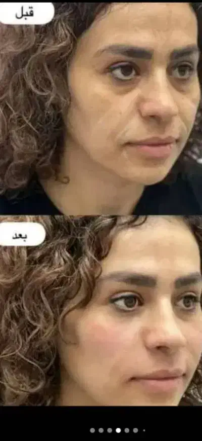 لیزر خانم آقا ژل بوتاکس هایفو لاغری امبدینگ|خدمات آرایشگری و زیبایی|سیرجان, |دیوار