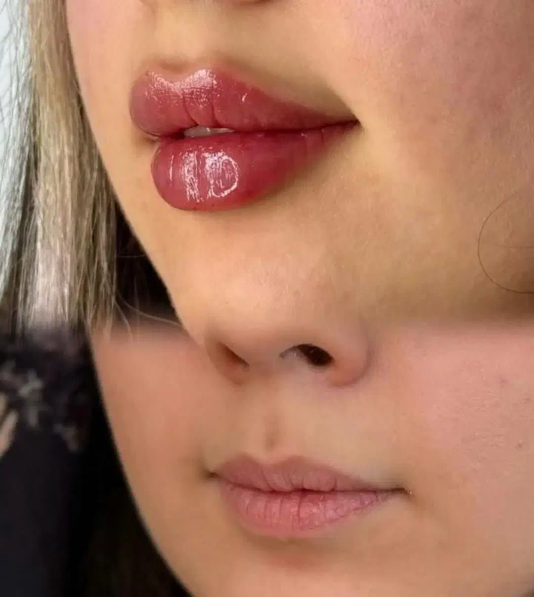 تزریق ژل دور چشم . بیکینی لیفت صورت بانخ مزوتراپی|خدمات آرایشگری و زیبایی|شاهین‌شهر, عطار|دیوار