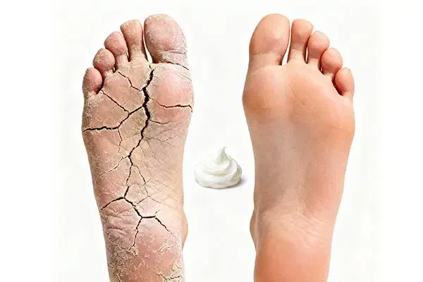 درمان قطعی ترک پا|آرایشی، بهداشتی، درمانی|شادگان, |دیوار