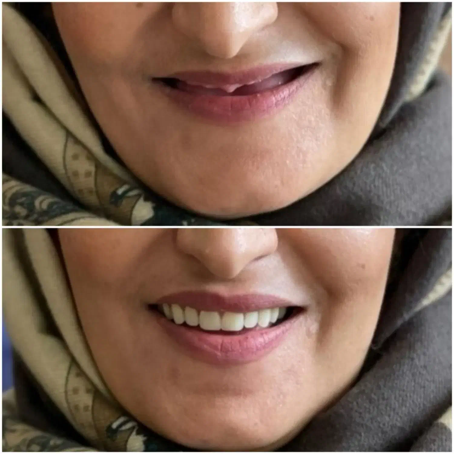 دندان مصنوعی و دندانسازی ، خدمات دندان سازی|خدمات آرایشگری و زیبایی|مشهد, شفا|دیوار