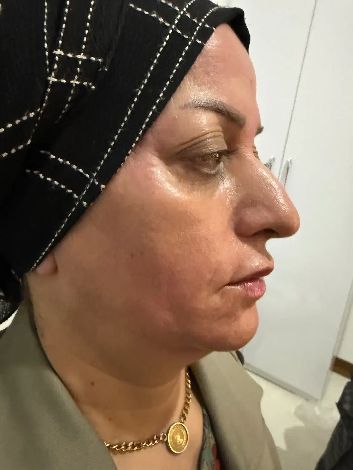 ژل و بوتاکس|خدمات آرایشگری و زیبایی|قاسم‌آباد (خواف), |دیوار