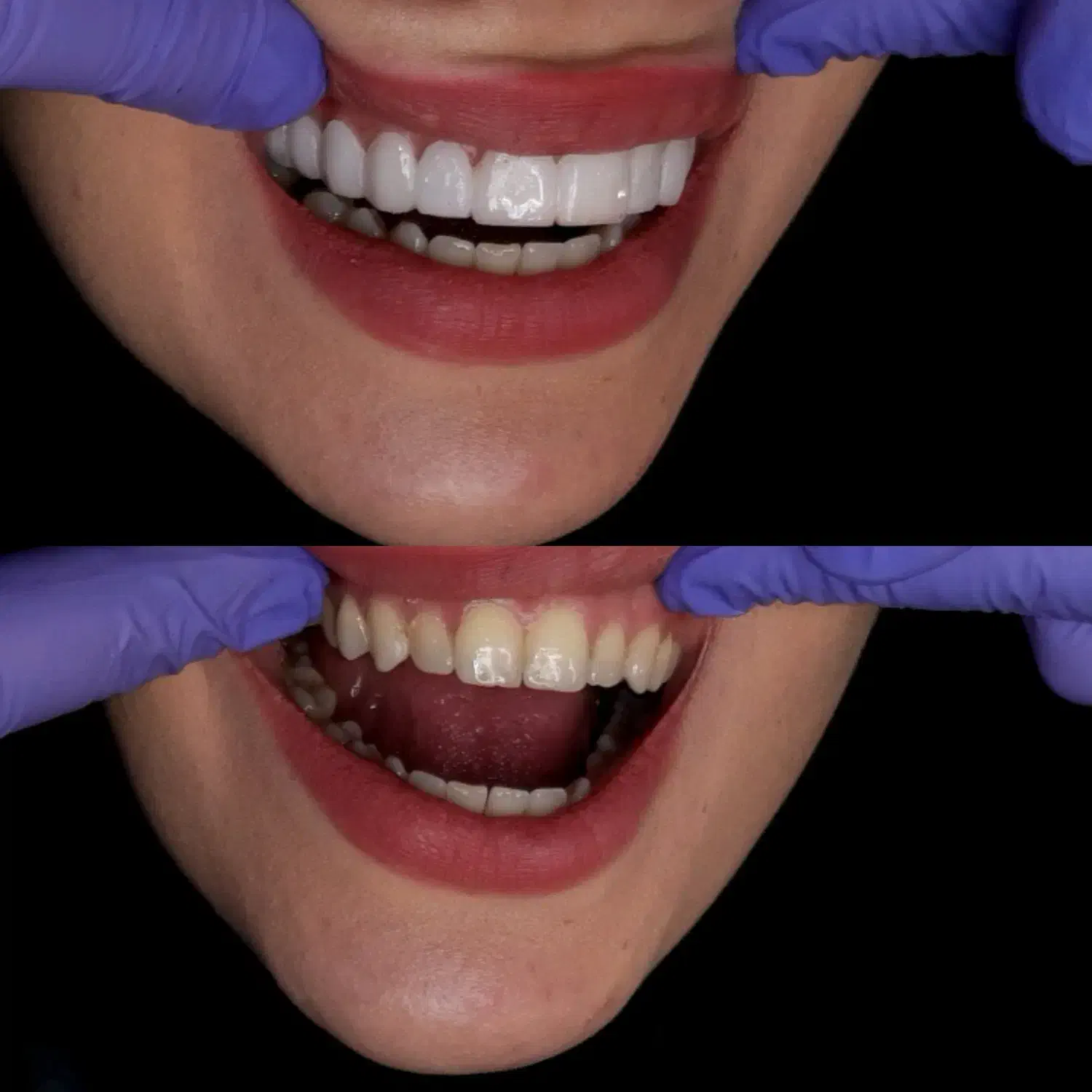 انجام لمینت متحرک دندان|خدمات آرایشگری و زیبایی|تهران, تهرانپارس غربی|دیوار