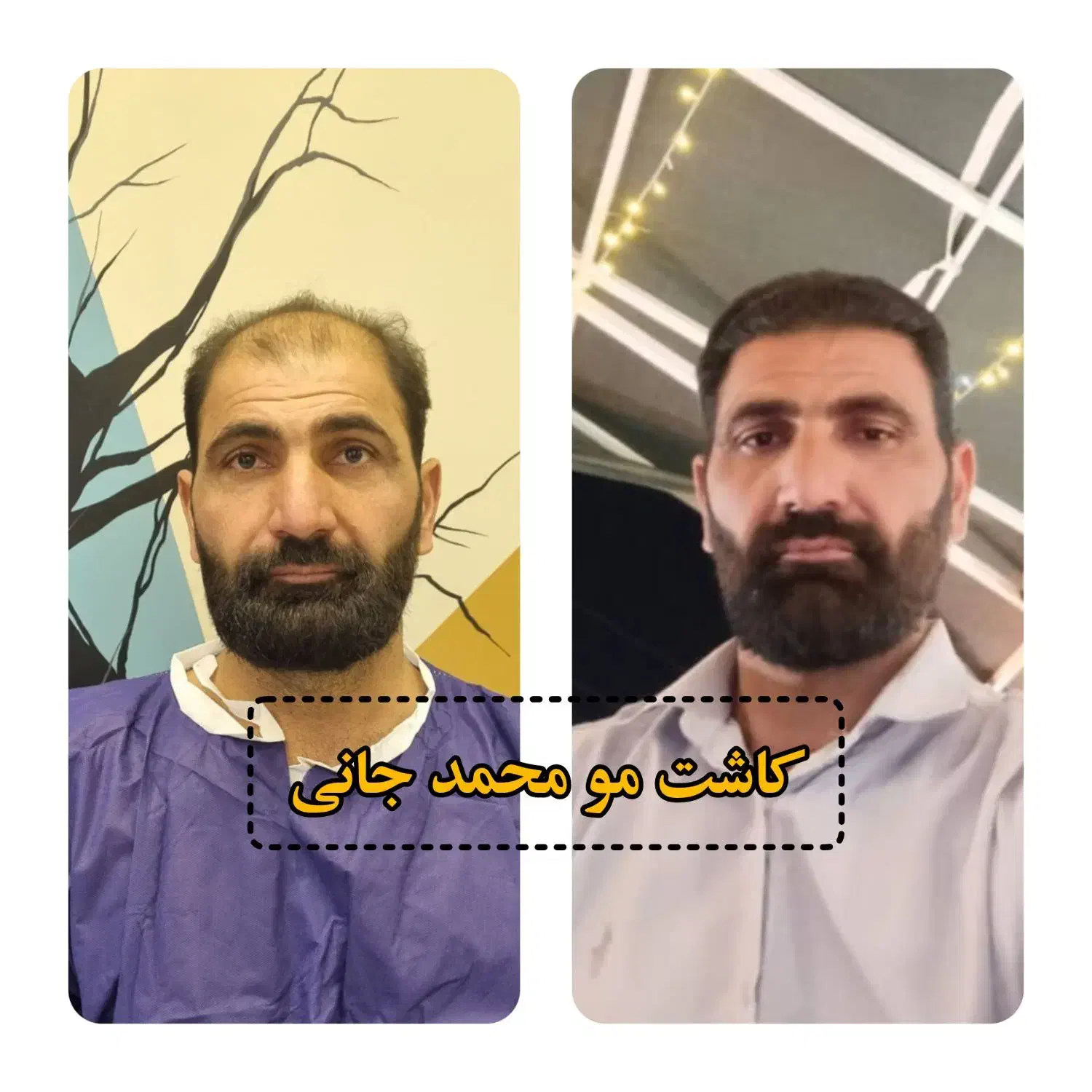 کاشت مو و ابرو و ریش|خدمات آرایشگری و زیبایی|ارسنجان, |دیوار
