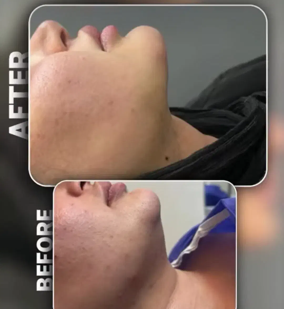 تزریق چربی .فیلر.نخ.ژل|خدمات آرایشگری و زیبایی|جهرم, |دیوار