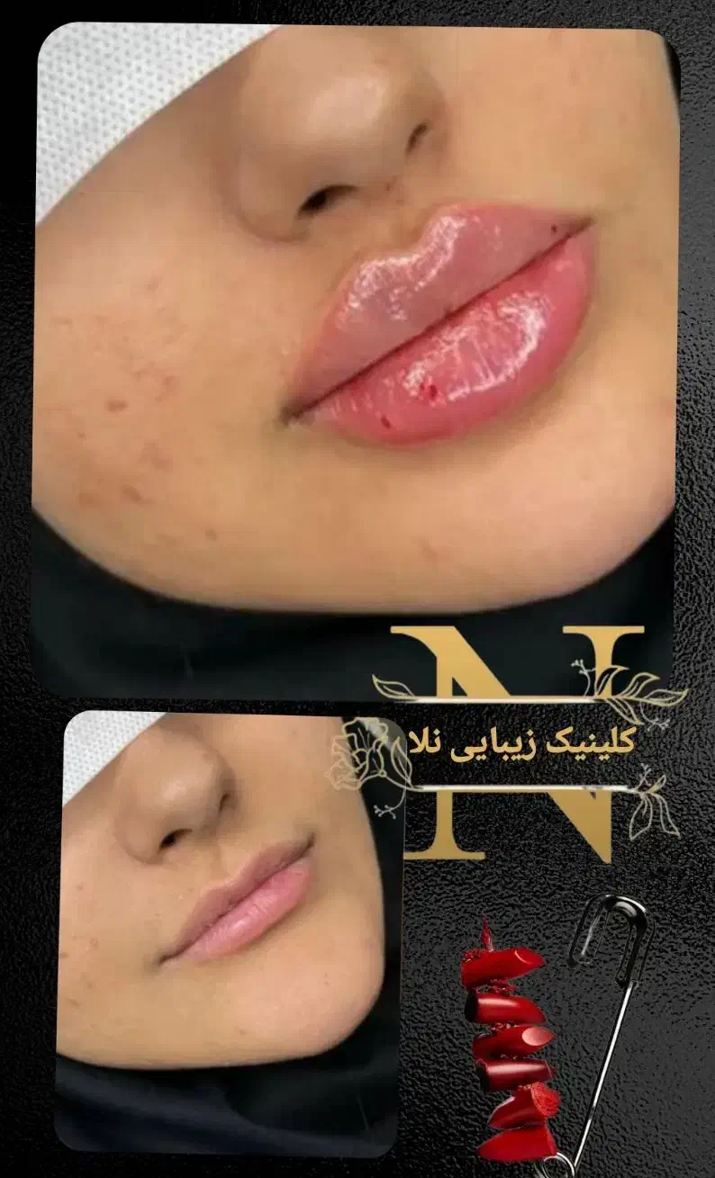 ژل بوتاکس خالبرداری|خدمات آرایشگری و زیبایی|زابل, |دیوار