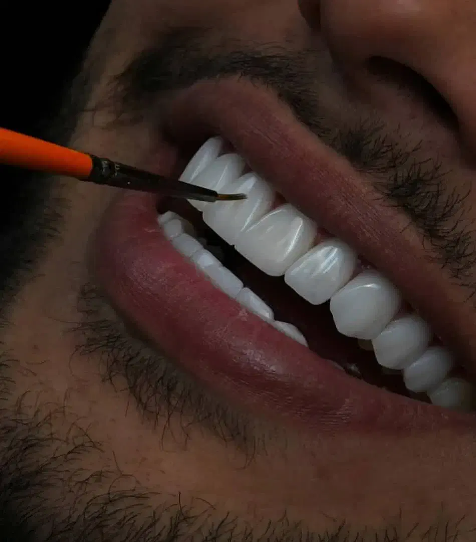 جشنواره کامپوزیت لمینیت عصب کشی روکش imax|خدمات آرایشگری و زیبایی|تهران, اقدسیه|دیوار