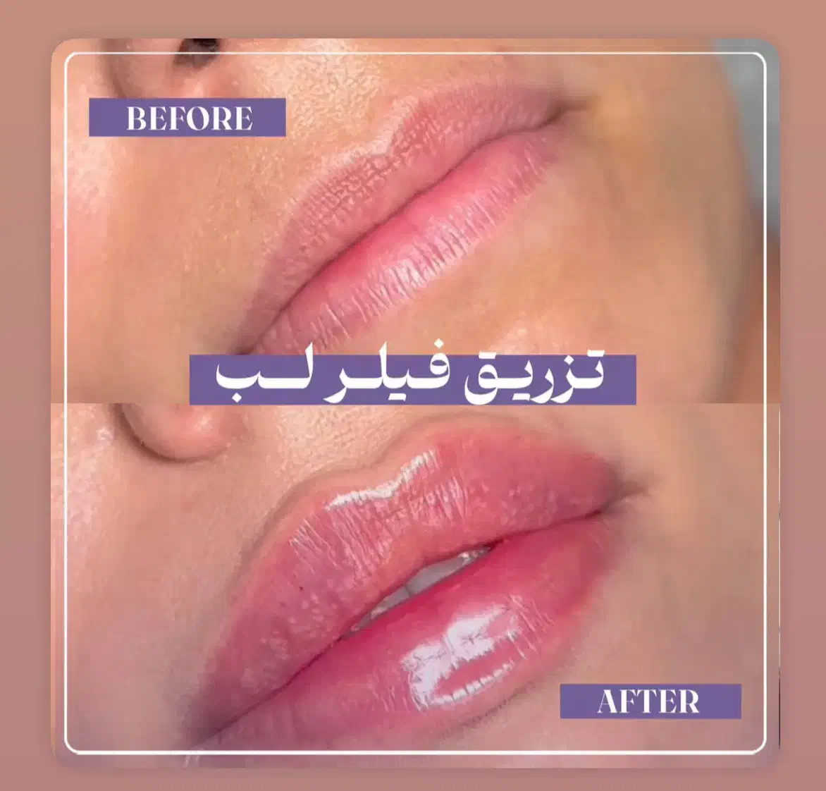 فیلر لب ۱/۶۰۰/تاپایان این هفته|خدمات آرایشگری و زیبایی|رشت, کوی حسینی|دیوار