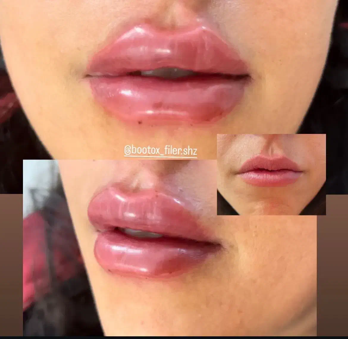 تزریق ژل با جدید ترین متد|خدمات آرایشگری و زیبایی|شیراز, لشکری‎|دیوار
