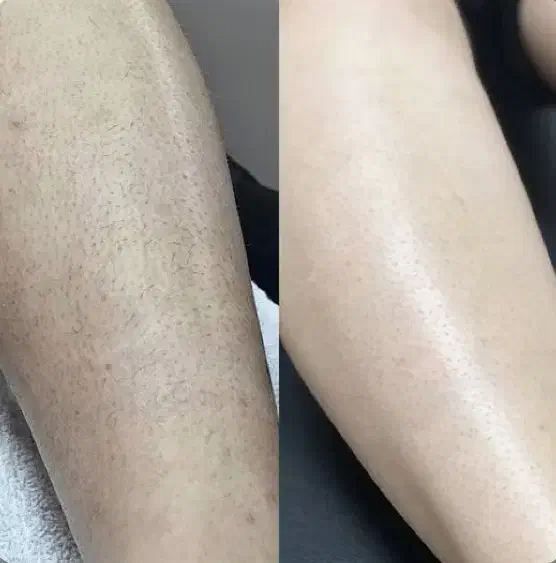 لیزر فول بادی فقط و فقط*۴۵۰ * بدوو که جا نمونی *|خدمات آرایشگری و زیبایی|زنجان, |دیوار