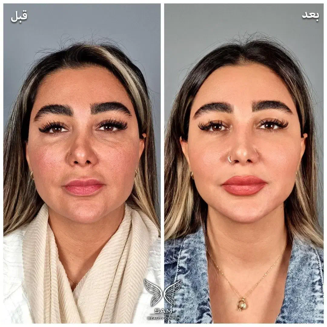 ۵۰ درصد تخفیف تزریق صورت سبک عربی هالیوودی لب روسی|خدمات آرایشگری و زیبایی|ری, دیلمان|دیوار