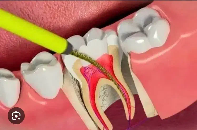 عصب کشی دندان های مولر (کرسی)|خدمات آرایشگری و زیبایی|بیرجند, |دیوار