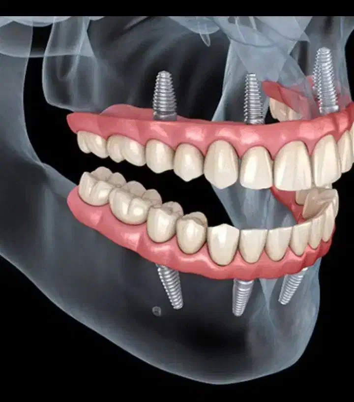 کاشت ایمپلنت|خدمات آرایشگری و زیبایی|پارس‌آباد, |دیوار