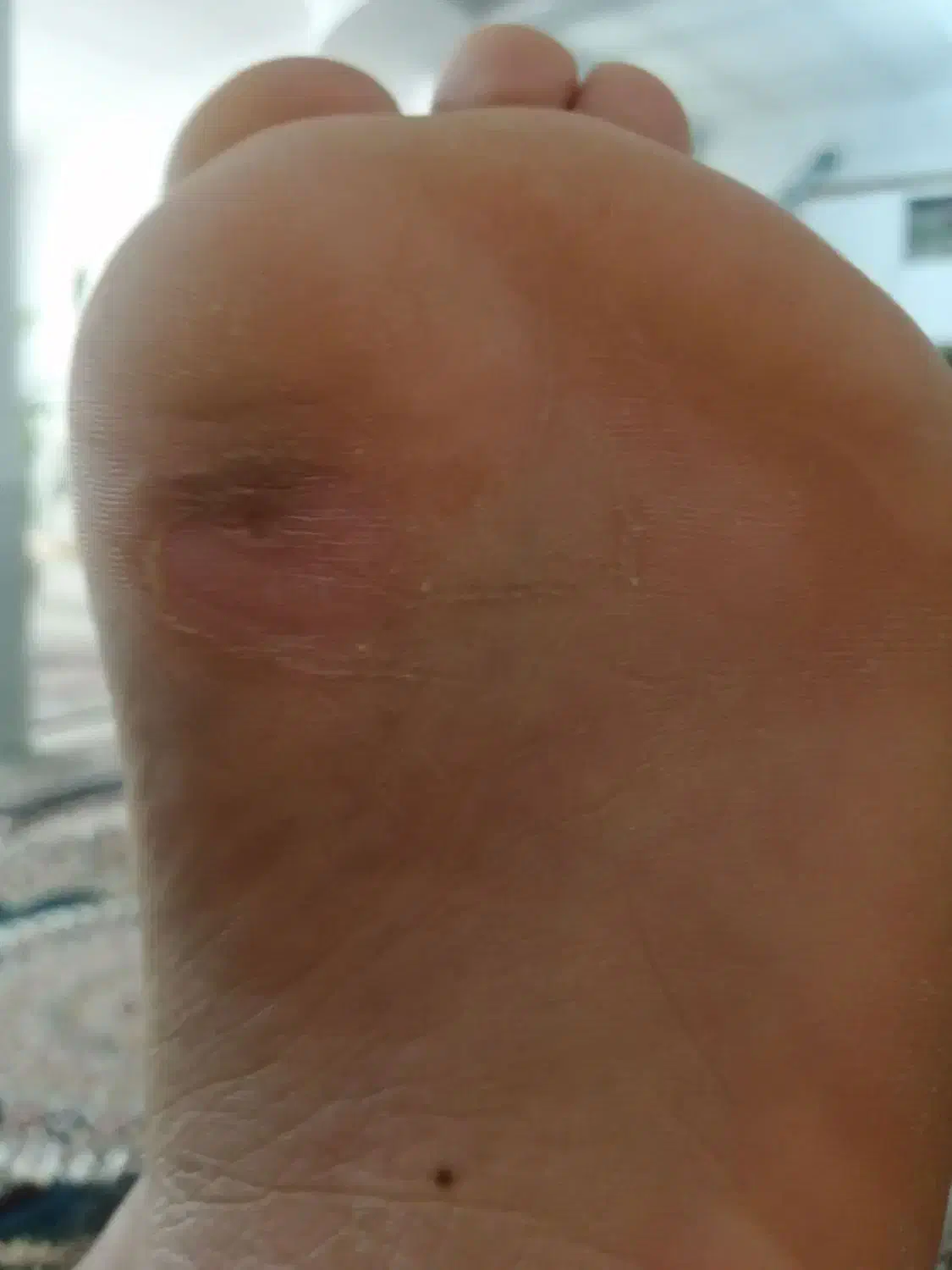 برداشتن خال زیگیل ومیخچه دست پابامحلول گیاهی|خدمات آرایشگری و زیبایی|نیشابور, بنیاد شهید|دیوار