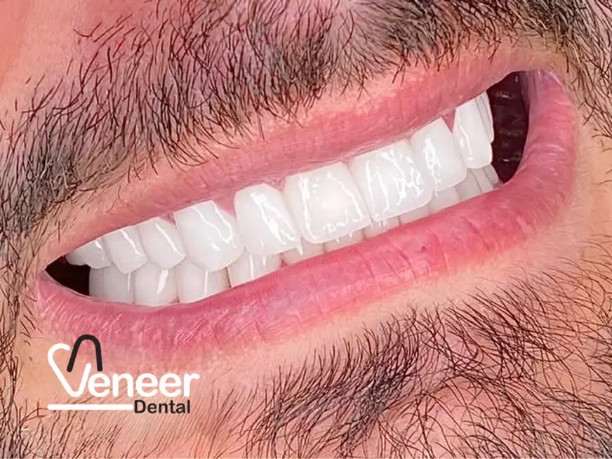دندانپزشکی ایمپلنت کامپوزیت لمینت ( اقساط بدون سود|خدمات آرایشگری و زیبایی|تهران, الهیه|دیوار