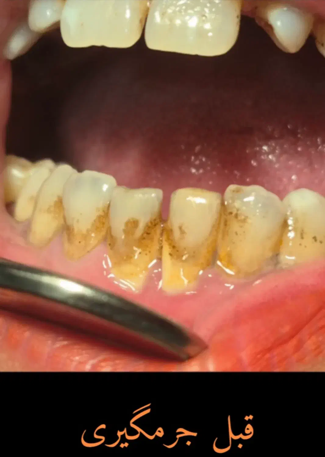 تخفیف ویژه جرمگیری تا ۱۵ آذر فقط ۱۸۰۰|خدمات آرایشگری و زیبایی|رشت, گلسار|دیوار