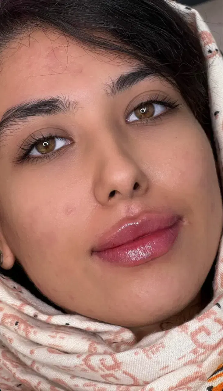 تزریق ژل و بوتاکس هایفو مزو پی ار پی ۸۹۹|خدمات زیبایی و سلامت|تهران, شکوفه (عبدل آباد)|دیوار