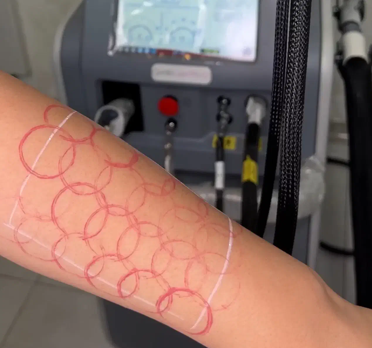 آموزش اپراتوری لیزر موهای زائد با دستگاه کندلا|خدمات آموزشی|پاکدشت, پاکدشت (مامازند)|دیوار