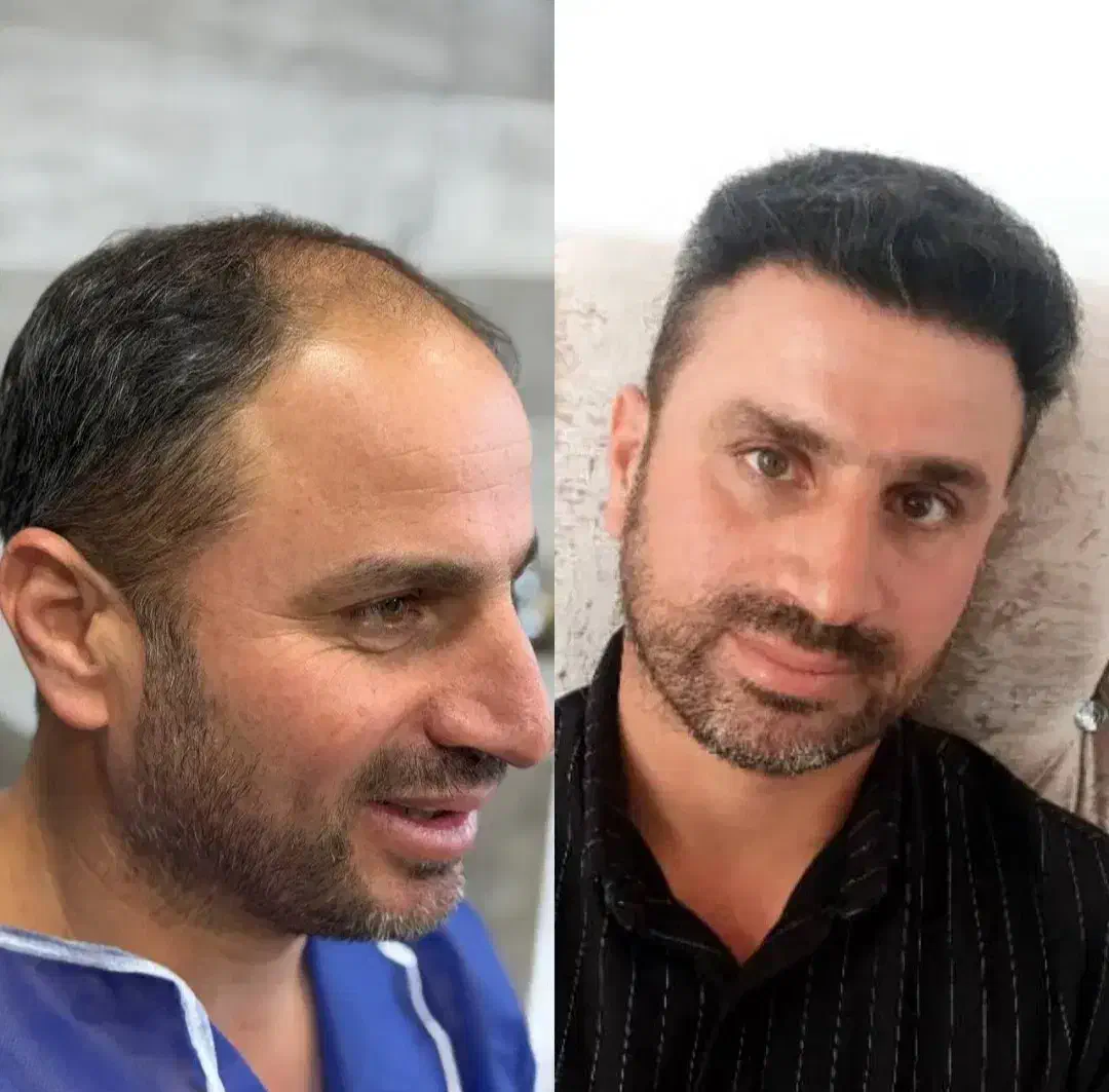 کاشت مو و ابرو|خدمات آرایشگری و زیبایی|بوشهر, |دیوار