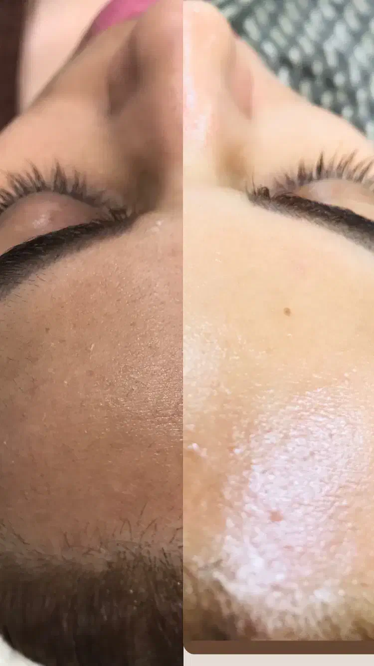 اصلاح صورت درما|خدمات آرایشگری و زیبایی|زابل, |دیوار