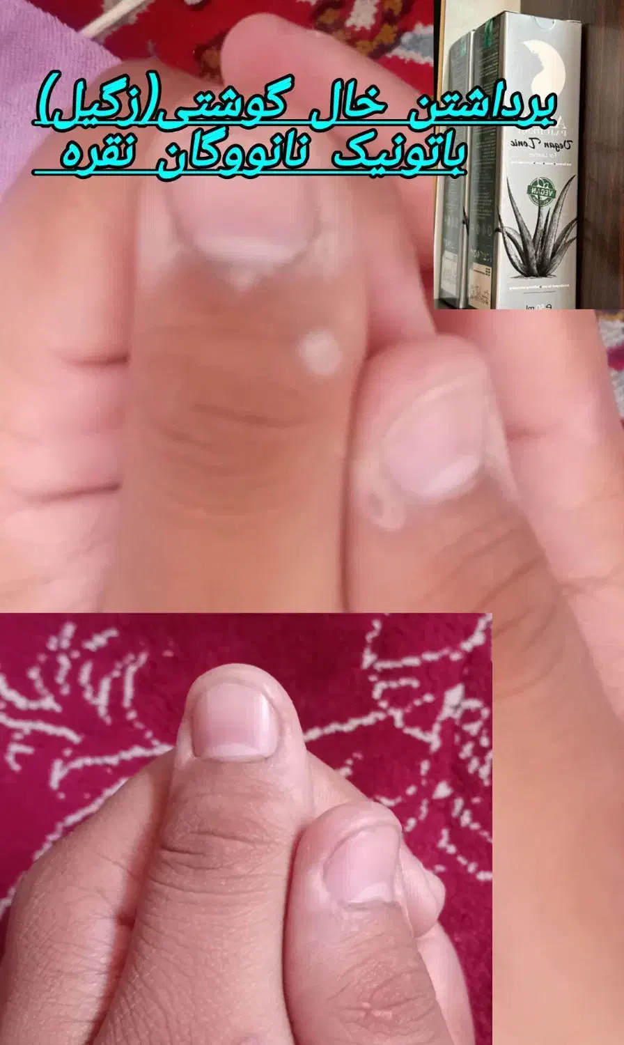 ترک پا،میخچه، اگزما|آرایشی، بهداشتی، درمانی|قروه, |دیوار